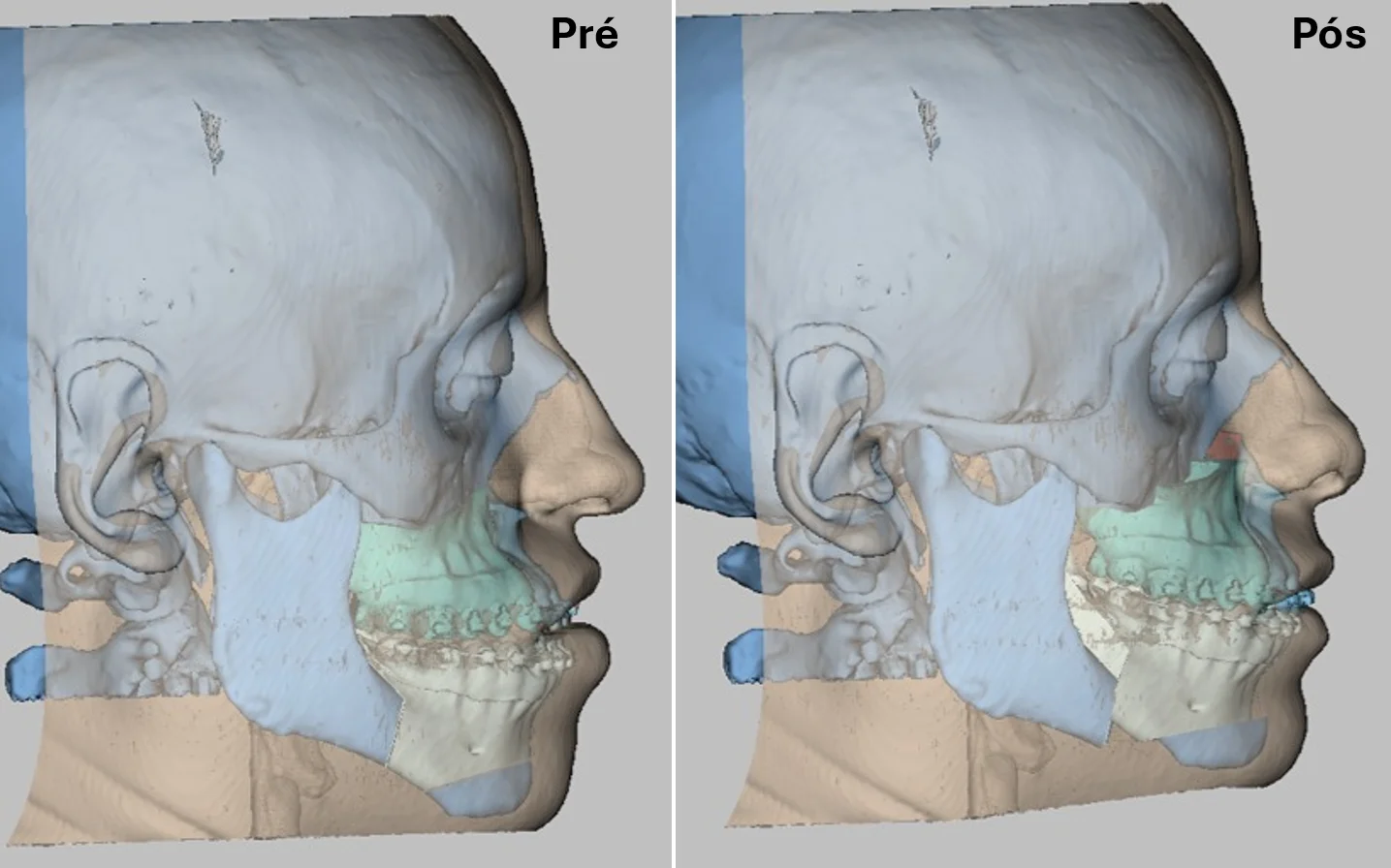 Avaliação clínica para cirurgia ortognática