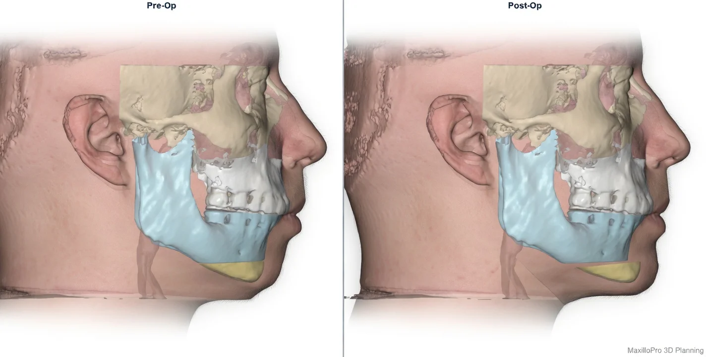 Planejamento cirúrgico para mentoplastia