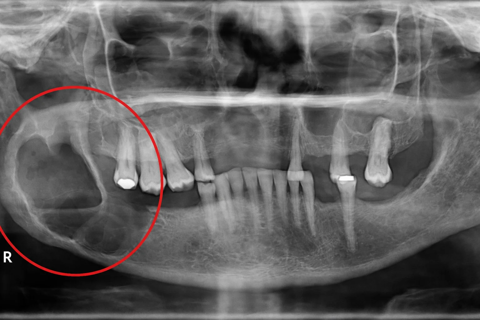 Avaliação clínica de patologia oral